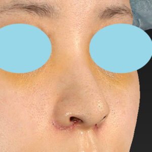 新宿ラクル美容外科クリニック　山本厚志　「貴族手術（鼻翼基部プロテーゼ）＋ 小鼻縮小+α法」　手術後１週間目　９月２８日