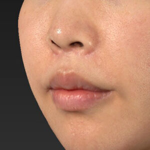 新宿ラクル美容外科クリニック　山本厚志　「人中短縮術（リップリフト）＋口角挙上（スマイルリップ）」　手術後１２ヶ月目　４月３日