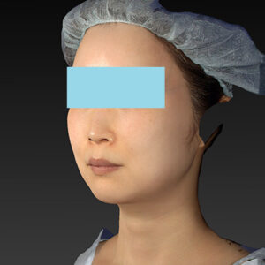 新宿ラクル美容外科クリニック　山本厚志　「アルテミスリフト」　手術後１２ヶ月目　４月１６日