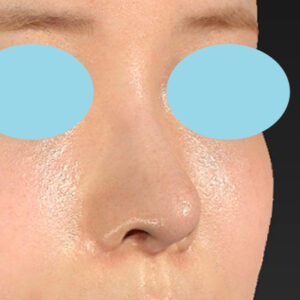 「鼻中隔延長修正＋耳介軟骨移植修正＋鼻尖形成修正＋小鼻縮小＋α法修正＋鼻柱下降＋猫手術＋真皮脂肪移植（鼻尖）」　新宿ラクル美容外科クリニック　２０代女性　手術後１２ヶ月目　４月２４日