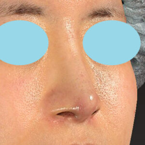 「鼻孔縁下降術＋小鼻縮小＋α法＋耳介軟骨移植＋鼻尖縮小（close法）＋真皮脂肪移植＋猫手術」　新宿ラクル美容外科クリニック　山本厚志　２０代女性　手術後１ヶ月目　９月１９日