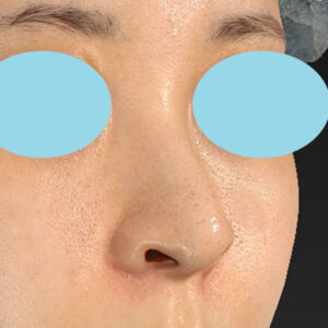 新宿ラクル美容外科クリニック　山本厚志　「貴族手術（鼻翼基部プロテーゼ）＋ 小鼻縮小+α法」　手術後１ヶ月目　９月２８日