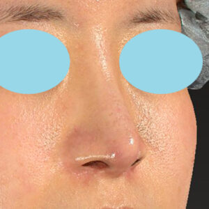 「鼻孔縁下降術＋小鼻縮小＋α法＋耳介軟骨移植＋鼻尖縮小（close法）＋真皮脂肪移植＋猫手術」　新宿ラクル美容外科クリニック　山本厚志　２０代女性　手術後２ヶ月目　９月１９日