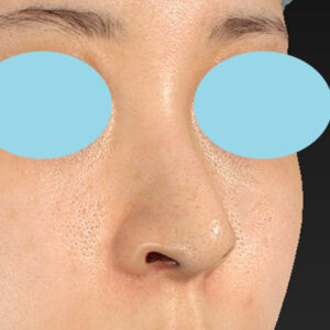 新宿ラクル美容外科クリニック　山本厚志　「貴族手術（鼻翼基部プロテーゼ）＋ 小鼻縮小+α法」　手術後２ヶ月目　９月２８日