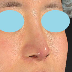 「鼻孔縁下降術＋小鼻縮小＋α法＋耳介軟骨移植＋鼻尖縮小（close法）＋真皮脂肪移植＋猫手術」　新宿ラクル美容外科クリニック　山本厚志　２０代女性　手術後３ヶ月目　９月１９日