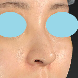 新宿ラクル美容外科クリニック　山本厚志　「貴族手術（鼻翼基部プロテーゼ）＋ 小鼻縮小+α法」　手術後３ヶ月目　１０月１０日