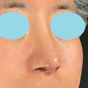 「鼻孔縁下降術＋小鼻縮小＋α法＋耳介軟骨移植＋鼻尖縮小（close法）＋真皮脂肪移植＋猫手術」　新宿ラクル美容外科クリニック　山本厚志　２０代女性　手術後６ヶ月目　９月１９日