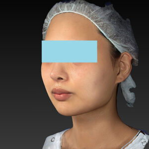 新宿ラクル美容外科クリニック　山本厚志　「アルテミスリフト＋ライポライフ脂肪吸引（メーラーファット+ジョールファット）」　手術後６ヶ月目　１１月２７日