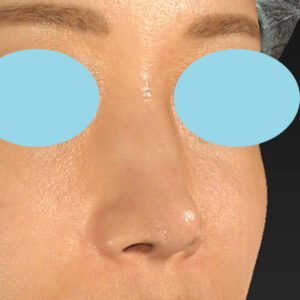 新宿ラクル美容外科クリニック　山本厚志　「鼻孔縁下降術」　手術後１２ヶ月目　１１月３０日