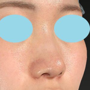 「小鼻縮小+α＋鼻尖縮小（close法）」　新宿ラクル美容外科クリニック　２０代女性　手術後６ヶ月目　１２月６日