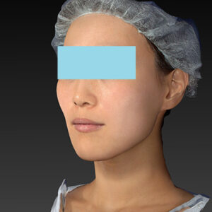 新宿ラクル美容外科クリニック　山本厚志　「アルテミスリフト」　手術後６ヶ月目　１２月８日