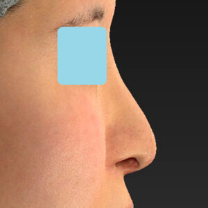 「鼻孔縁下降術＋小鼻縮小＋α法＋耳介軟骨移植＋鼻尖縮小（close法）＋真皮脂肪移植＋猫手術」　新宿ラクル美容外科クリニック　山本厚志　２０代女性　手術前　９月１９日