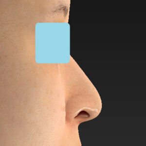 新宿ラクル美容外科クリニック　山本厚志　「貴族手術（鼻翼基部プロテーゼ）＋ 小鼻縮小+α法」　手術前　９月２８日