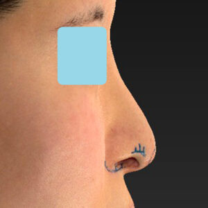 「鼻孔縁下降術＋小鼻縮小＋α法＋耳介軟骨移植＋鼻尖縮小（close法）＋真皮脂肪移植＋猫手術」　新宿ラクル美容外科クリニック　山本厚志　２０代女性　デザイン　９月１９日