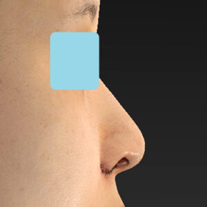 新宿ラクル美容外科クリニック　山本厚志　「貴族手術（鼻翼基部プロテーゼ）＋ 小鼻縮小+α法」　手術直後　９月２８日