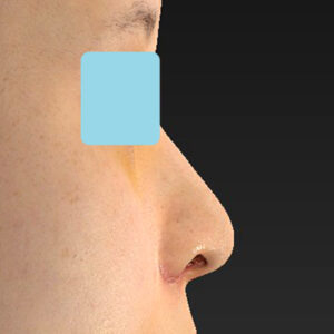 新宿ラクル美容外科クリニック　山本厚志　「貴族手術（鼻翼基部プロテーゼ）＋ 小鼻縮小+α法」　手術後１週間目　９月２８日