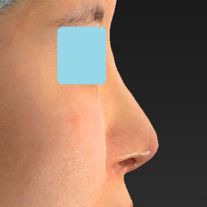 「鼻孔縁下降術＋小鼻縮小＋α法＋耳介軟骨移植＋鼻尖縮小（close法）＋真皮脂肪移植＋猫手術」　新宿ラクル美容外科クリニック　山本厚志　２０代女性　手術後１ヶ月目　９月１９日