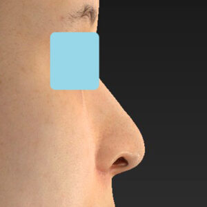 新宿ラクル美容外科クリニック　山本厚志　「貴族手術（鼻翼基部プロテーゼ）＋ 小鼻縮小+α法」　手術後１ヶ月目　９月２８日