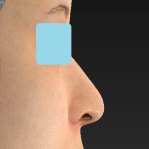 新宿ラクル美容外科クリニック　山本厚志　「貴族手術（鼻翼基部プロテーゼ）＋ 小鼻縮小+α法」　手術後２ヶ月目　９月２８日