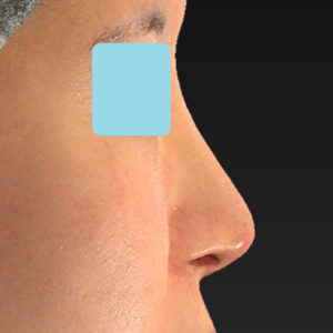 「鼻孔縁下降術＋小鼻縮小＋α法＋耳介軟骨移植＋鼻尖縮小（close法）＋真皮脂肪移植＋猫手術」　新宿ラクル美容外科クリニック　山本厚志　２０代女性　手術後６ヶ月目　９月１９日