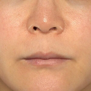 新宿ラクル美容外科クリニック　山本厚志　「人中短縮術（リップリフト）＋口角挙上（スマイルリップ）」　手術前　１０月２８日