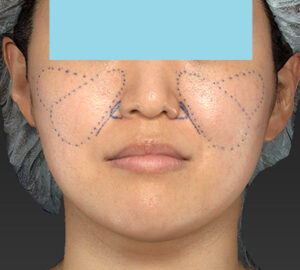 新宿ラクル美容外科クリニック　山本厚志　「ライポライフ脂肪吸引（メーラーファット）＋貴族手術」　デザイン　１０月１０日