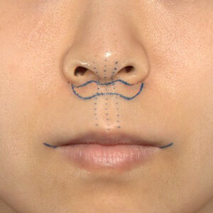 新宿ラクル美容外科クリニック　山本厚志　「人中短縮術（リップリフト）＋口角挙上（スマイルリップ）」　デザイン　１０月１３日