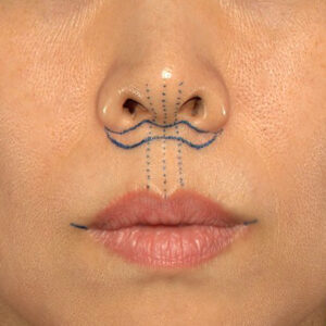 新宿ラクル美容外科クリニック　山本厚志　「人中短縮術（リップリフト）」　デザイン　１０月１４日