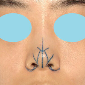 「小鼻縮小+α＋鼻尖縮小（close法）」　新宿ラクル美容外科クリニック　２０代女性　デザイン　１０月１５日