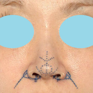 「耳介軟骨移植＋鼻尖縮小（close法）＋小鼻縮小+α＋貴族手術」　新宿ラクル美容外科クリニック　３０代女性　デザイン　１０月２１日