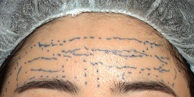 デザイン 新宿ラクル美容外科クリニック 山本厚志 「額の若返り(ジュビダームビスタ・ボリューマXC)」 デザイン 10月23日