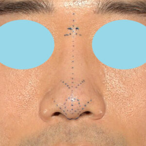 「鼻中隔延長＋耳介軟骨移植＋鼻尖形成＋鼻柱下降＋猫手術＋真皮脂肪移植（鼻尖）＋鼻プロテーゼ隆鼻術」　新宿ラクル美容外科クリニック　２０代女性　デザイン　１０月２２日