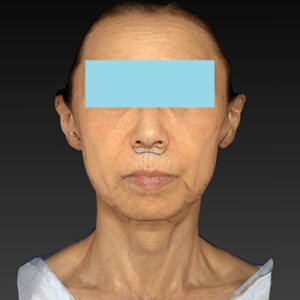 新宿ラクル美容外科クリニック　山本厚志　ナチュラルフェイスネックリフト　デザイン　１０月２５日