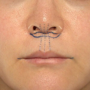 新宿ラクル美容外科クリニック　山本厚志　「人中短縮術（リップリフト）＋口角挙上（スマイルリップ）」　デザイン　１０月２８日