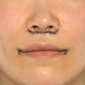 新宿ラクル美容外科クリニック　山本厚志　「人中短縮術（リップリフト）＋口角挙上（スマイルリップ）」　手術直後　１０月１１日