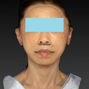 新宿ラクル美容外科クリニック　山本厚志　ナチュラルフェイスネックリフト　手術直後　１０月２５日