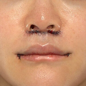 新宿ラクル美容外科クリニック　山本厚志　「人中短縮術（リップリフト）＋口角挙上（スマイルリップ）」　手術直後　１０月２８日