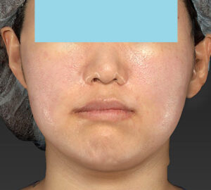 新宿ラクル美容外科クリニック　山本厚志　「ライポライフ脂肪吸引（メーラーファット）＋貴族手術」　手術直後　１０月１０日