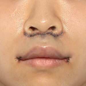 新宿ラクル美容外科クリニック　山本厚志　「人中短縮術（リップリフト）＋口角挙上（スマイルリップ）」　手術直後　１０月１３日