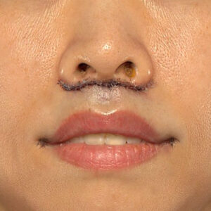 新宿ラクル美容外科クリニック　山本厚志　「人中短縮術（リップリフト）」　手術直後　１０月１４日