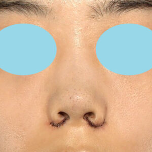 「小鼻縮小+α＋鼻尖縮小（close法）」　新宿ラクル美容外科クリニック　２０代女性　手術直後　１０月１５日