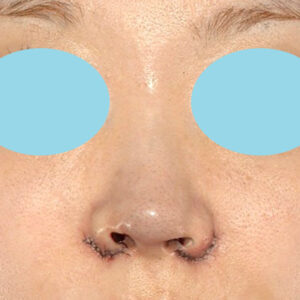 「耳介軟骨移植＋鼻尖縮小（close法）＋小鼻縮小+α＋貴族手術」　新宿ラクル美容外科クリニック　３０代女性　手術直後　１０月２１日