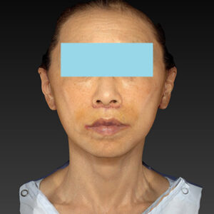 新宿ラクル美容外科クリニック　山本厚志　ナチュラルフェイスネックリフト　手術後１週間目　１０月２５日