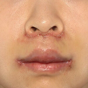 新宿ラクル美容外科クリニック　山本厚志　「人中短縮術（リップリフト）＋口角挙上（スマイルリップ）」　手術後１週間目　１０月１３日