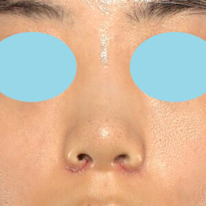 「小鼻縮小+α＋鼻尖縮小（close法）」　新宿ラクル美容外科クリニック　２０代女性　手術後１週間目　１０月１５日