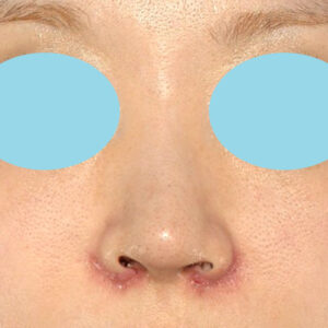 「耳介軟骨移植＋鼻尖縮小（close法）＋小鼻縮小+α＋貴族手術」　新宿ラクル美容外科クリニック　３０代女性　手術後１週間目　１０月２１日