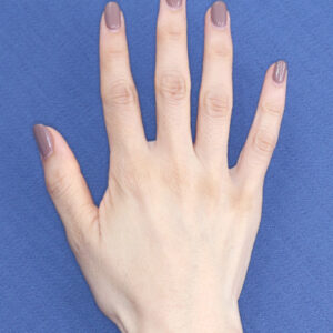 新宿ラクル美容外科クリニック　山本厚志　「手の若返り（プレミアムPRP×FGF皮膚再生療法）」　治療後１２ヶ月目　１１月１３日