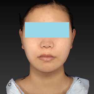 新宿ラクル美容外科クリニック　山本厚志　ナチュラルフェイスリフト　手術後１２ヶ月目　３月２９日