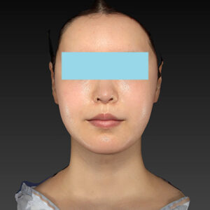 新宿ラクル美容外科クリニック　山本厚志　ナチュラルフェイスリフト　手術後１２ヶ月目　４月３０日