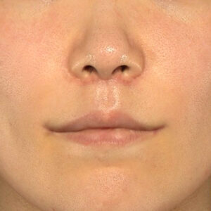 新宿ラクル美容外科クリニック　山本厚志　「人中短縮術（リップリフト）＋口角挙上（スマイルリップ）」　手術後１ヶ月目　１０月１１日